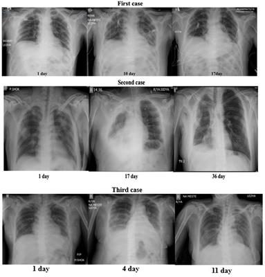 Case series report: use of vibroacoustic pulmonary therapy in patients with thoracic trauma complicated by acute respiratory failure